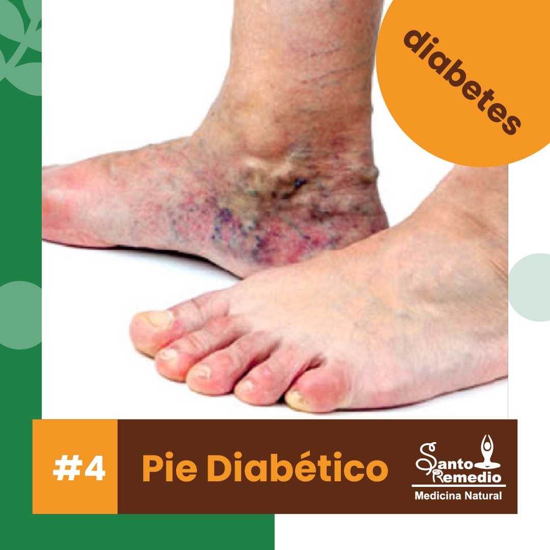 🦶 El pie diabético es una úlcera en los tejidos que forman el pie en pacientes con Diabetes.

Las ulceraciones del pie diabético normalmente se infectan fácilmente y esto, junto con problemas de circulación y afectación de nervios y vasos sanguíneos, aporta menor sangre a los tejidos, pudiendo conllevar a gangrena; esto puede provocar la necesidad de amputar, en casos extremos.

Los síntomas del pie diabético son:
👉 Hormigueos y calambres en los pies
👉 No tiene sensibilidad en los pies
👉 Las heridas en los pies se le convierten en úlceras
.
Algunas hierbas que puedes usar para las úlceras son la sangre de drago y la plata líquida.
.

⚠️ Cuida tus pies de una amputación controlando lo que ingieres por tu boca, con tu propia cuchara.

Porque lo natural siempre ha sido mejor, ❤yo amo lo natural❤ sin efectos químicos en mi cuerpo, pedidos directos al whatsapp 6062-0101

Judith Jurado Naturista y Psicóloga 👩‍💼
.
.
#diabetes #piediabetico #cegueradiabetica #hemoglobinaglicosilada #riñonesdiabeticos #tiposdiabetes #comidadiabetes #alpiste #cromo #insulina #glucosa #azucarensangre #diabetesmellitus #saludfisica #tipsdesalud #salud #botanica #medicinanatural #hierbas #sinquimicos #yoAMOlonatural #farmaciaonline #SantoRemedioPanama #JudithJuradoNaturistayPsicologa